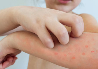 Friburgo tem dois casos de sarampo confirmados este ano e outros 10 estão sendo investigados