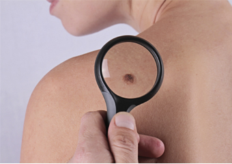 Melanomas: autoexame da pele auxilia na prevenção
