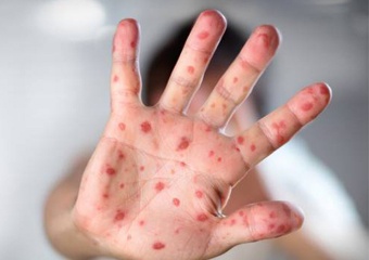 Friburgo: Sobe para 7 número de casos confirmados de sarampo