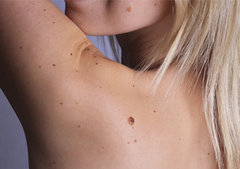 Nova Friburgo terá ações de combate ao câncer de pele nesse sábado