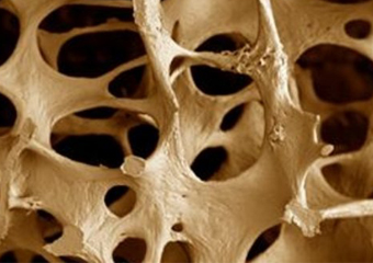 10 Coisas que cocê precisa saber sobre osteoporose